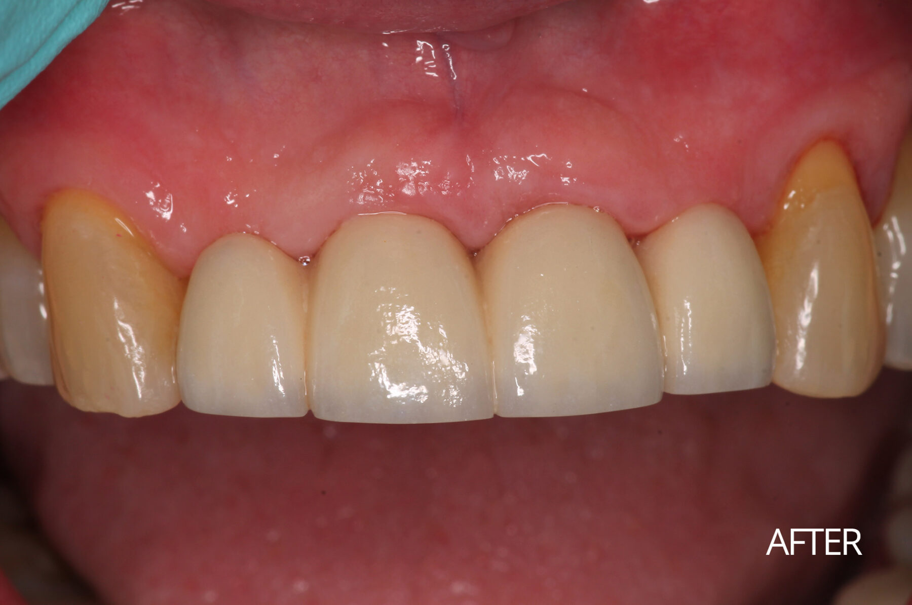 Dental Implants After | Villiage Periodontics