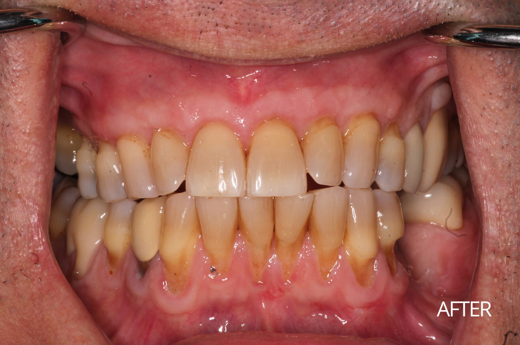 Gum Tissue Repair After | Village Periodontics