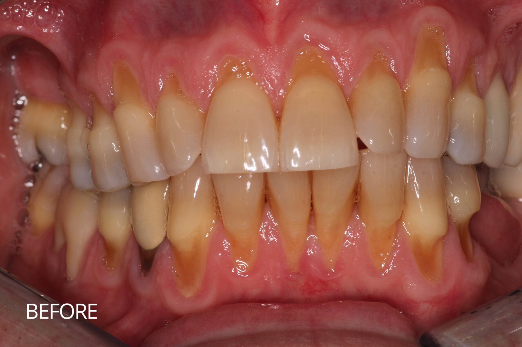 Gum Tissue Repair Before | Village Periodontics