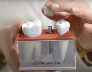 How Do Dental Implants Work | Village Periodontics